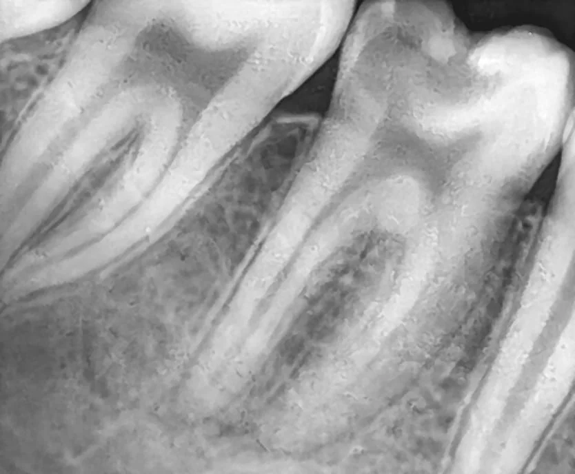 Radiografia antes do tratamento de canal, com os canais do dente ainda sem tratamento