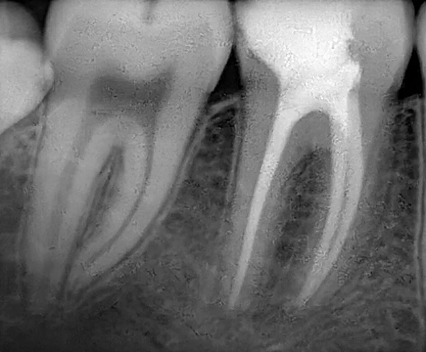 Radiografia depois do tratamento de canal, com os canais preenchidos e tratados