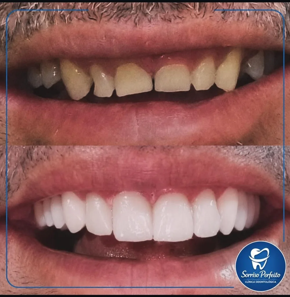Antes e depois de lentes de resina: em cima, dentes escurecidos e desalinhados; embaixo, sorriso claro e alinhado após o tratamento na Sorriso Perfeito
